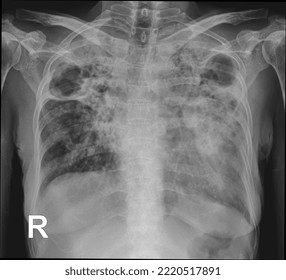 X-ray Examination Is Often Used To Support A Diagnosis Involving The Chest Wall, Sternum, And Those In The Chest Cavity Including The Lungs, Heart, And Others.