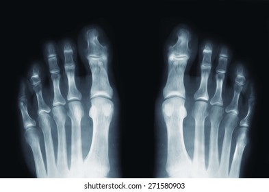 X Ray Feet X Ray Feet