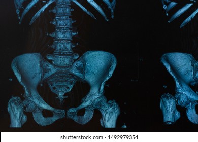 X-ray Of A Femoral Neck Fracture. Hip Fracture Due To Multiple Myeloma Disease. Bone Weakness.