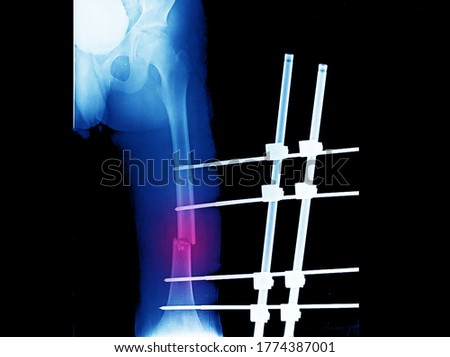 An x-ray of femur showing closed fracture with displacement at shaft of femur. The patient has compartment syndrome and needs fasciotomy and external fixation of the fracture.