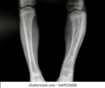 The X-ray Is Fibrous Dysplasia Of Both Tibia And Show Varus Deformity.