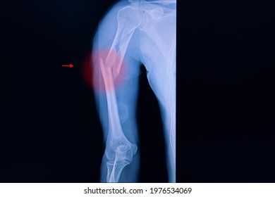 Xray Film Of An Arm Of A Patient Showing Humerus Fracture. Orthopedic Trauma.