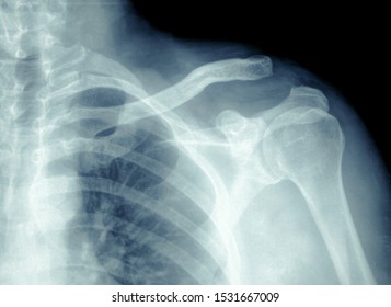 Xray Film Broken Shoulder Hd Xray Stock Photo 1531667009 | Shutterstock