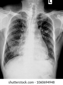 Chest Xray Pa View Stock Photo 261443930 | Shutterstock