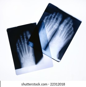 X-ray Film Of Feet On A Light Box