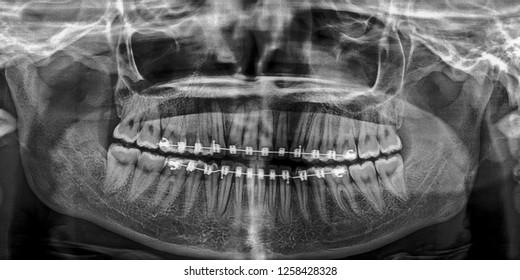 Full Mouth X Rays Template