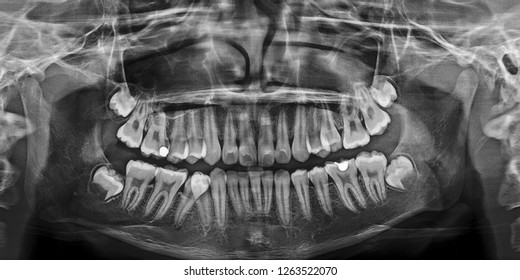 Full Mouth X Rays Template