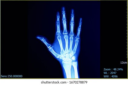 Xray Hand Images Stock Photos Vectors Shutterstock