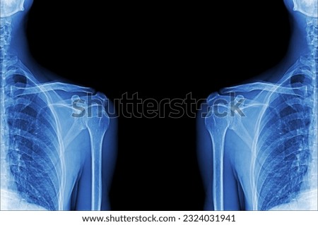 X-ray film of human shoulder