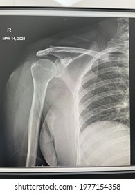 X-ray Film Of Human Skeleton, Shoulder , Bone Broken, Clavicle Bone 