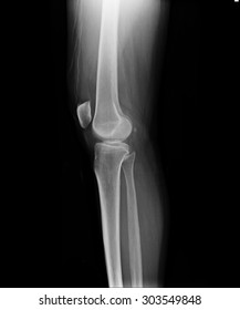 Plain Radiography Osteoarthritis Right Knees On Stock Photo 1225801219 ...