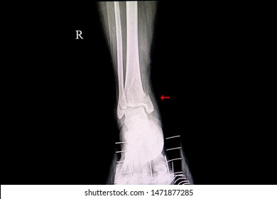 minimally displaced lateral malleolus fracture