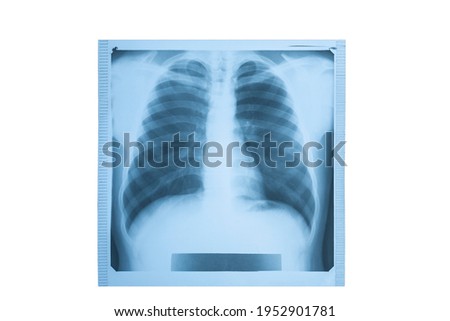 X-ray film of lungs on a white background. lung radiography concept. X-ray of a thorax.