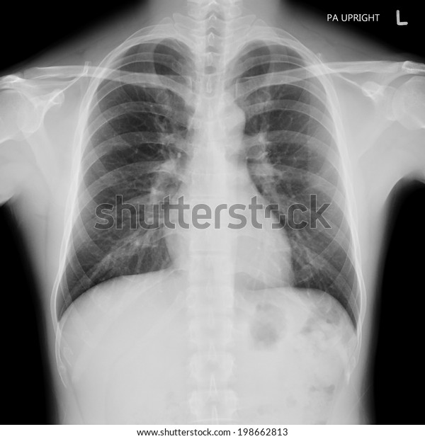 Xray Film Normal Male Chest Stock Photo (Edit Now) 198662813