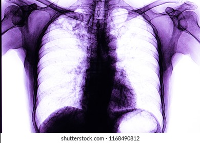 Xray Film Of A Patient With Active Pulmonary Tuberculosis With Cavitation In The Right Upper Lung. Infectious And Contagious Disease. TB Communicable Respiratory Disease. Color-enhancing Chest Film.