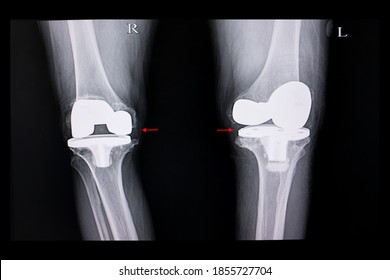 The X-ray Film Of A Patient Both Knees After Total Knee Arthroplasty Operation. TKA Operation,  Knee Prosthesis.