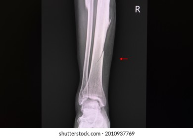 Película de rayos X de un paciente con fractura espiral cerrada no desplazada de tibia derecha (hueso inferior de la pierna).