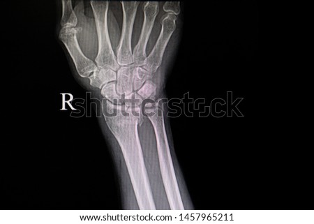 Xray film of a patient with fractured wrist bones. Showing fractures distal radius and ulna bones.