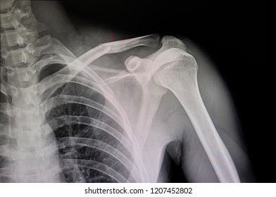 Xray Film Of A Patient With Hairline Fracture Of Clavicle.