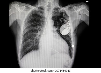 Xray Film Of A Patient With Heart Enlargement (white Arrow) And An Early Pulmonary Edema.  He Is Also Wearing A Cardiac Pacemaker.