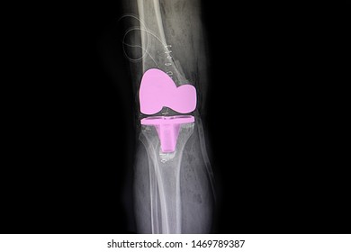 The X-ray Film Of A Patient Knee After Total Knee Arthroplasty Operation. TKA Operation,  Knee Prosthesis.