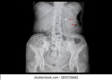 Xray Film Of A Patient With A Large Stone In The Left Renal Pelvis And Calcification In The Lower Pole The Kidney.