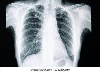 Xray Film Of A Patient With Pulmonary Tuberculosis With Fibrosis In The Right Upper Lung 