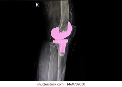 The X-ray Film Of A Patient Right Knee After Total Knee Arthroplasty Operation. TKA Operation,  Knee Prosthesis.