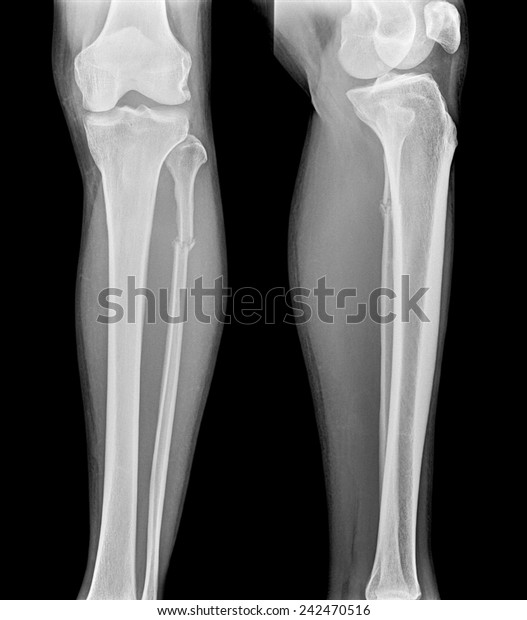 Xray Film Proximal Tibia Intra Articular Stock Photo (Edit Now) 242470516