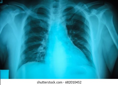 X-ray Film Rib Fractures