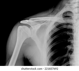 Shoulder Xray Showing Closed Fracture Displacement Stock Photo (Edit ...