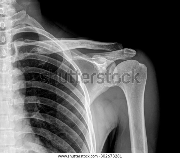 Xray Film Shoulder Stock Photo (Edit Now) 302673281