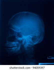 X Ray Film Skull Lateral Stock Photo 93276718 | Shutterstock