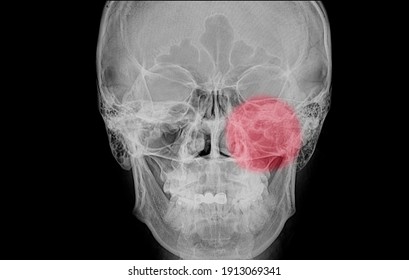 Xray Film Of A Skull Of A Patient (paranasal Sinus) With Acute Left Maxillary Sinusitis (red Circular Shade) With Haziness Of The Left Maxillary Air Cells.