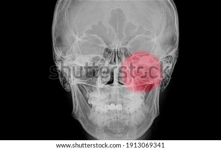 Xray film of a skull of a patient (paranasal sinus) with acute left maxillary sinusitis (red circular shade) with haziness of the left maxillary air cells.