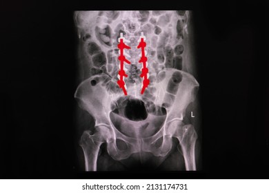 X-ray Film Of Spinal Metal Implants.