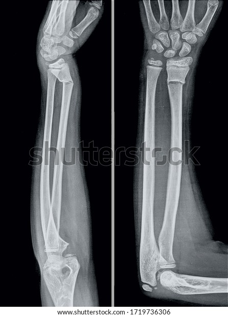 x-ray fixation of forearm fracture