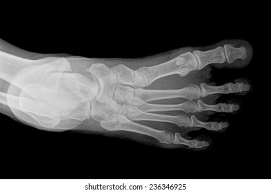 Xray Foot