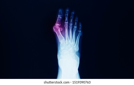 X-ray Of Foot And Ankle Showing Hallux Valgus Or Bunion. The Patient Has Pain At Big Toe And Deformity. Surgical Correction And Reconstruction Is Needed. 