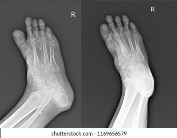 Metatarsal Images, Stock Photos & Vectors | Shutterstock