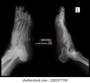 X-ray Of The Foot. Exostosis Of The 5th Metatarsal Bone. Marker.