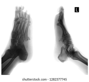 X-ray Of The Foot. Exostosis Of The 5th Metatarsal Bone. Negative.