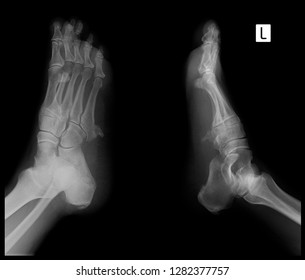 X-ray Of The Foot. Exostosis Of The 5th Metatarsal Bone. 