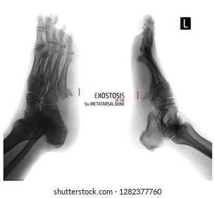 X-ray Of The Foot. Exostosis Of The 5th Metatarsal Bone. Negative. Marker.