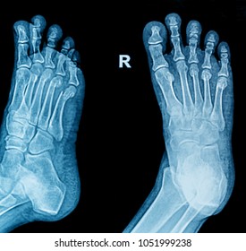 X-ray Foot Fracture