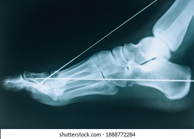 X-ray Of The Foot. Fracture Of The Bones Of The Foot. Bone Fixation Pins