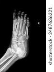 x-ray of foot fractured metatarsal bone. roken foot, oblique view, show fracture of 1th metatarsal bone. radiography, medical diagnostics, traumatology and orthopedics, rheumatology