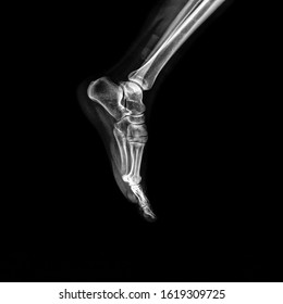 X-ray of foot on black background