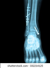 Xray Of Foot With Screw Front View