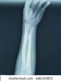 X-ray Forearm (AP) View Case Accident Fall Hight Finding Fracture At Left Ulnar And Left Radial Diaphysis With Displacement.Medical Healthcare Concept.